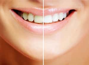 ホワイトニング