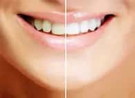 ホワイトニング